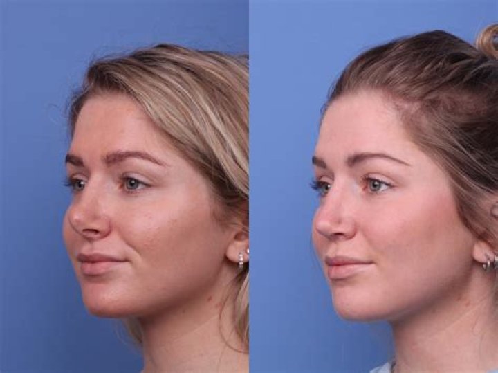 Annalisa Cochrane Nose Job and Plastic Surgery – Her “One Of Us Is Lying” Transformation
