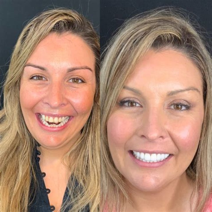 Cardi B’s New Teeth Costs $40k – Before and After Pictures of Smile Makeover | Dr. Catrise Austin is The Dentist