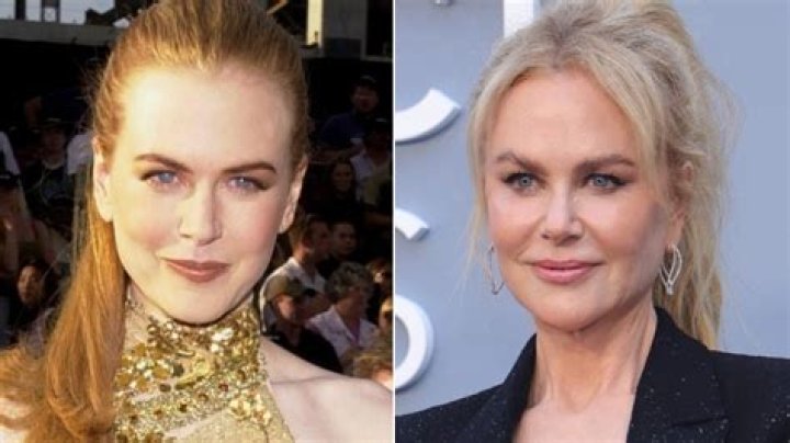 Celebrity Cosmetic Enhancements: Unveiling Nicole Kidman's Implants