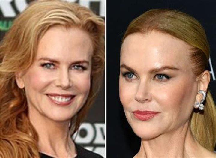 Transformations And Revelations: Nicole Kidman After Plastic Surgery