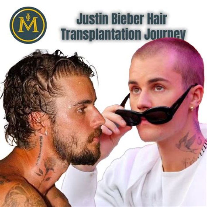 Unlocking The Secrets Behind Justin Bieber's Hair Transplantation Journey