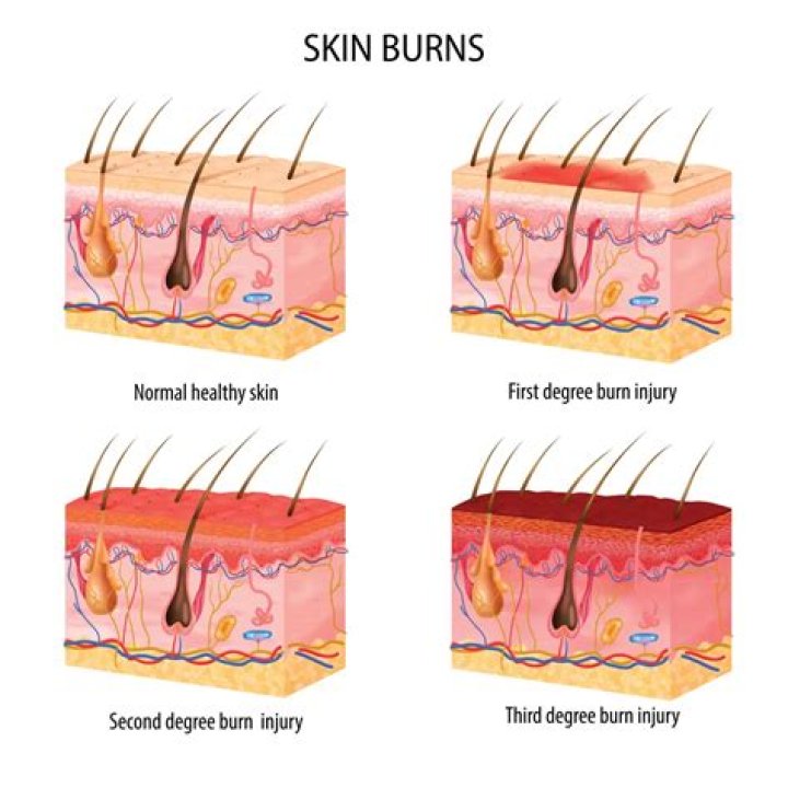 What Happened To Alison Dos Santos Head? 3rd Degree Burn And Hair Loss